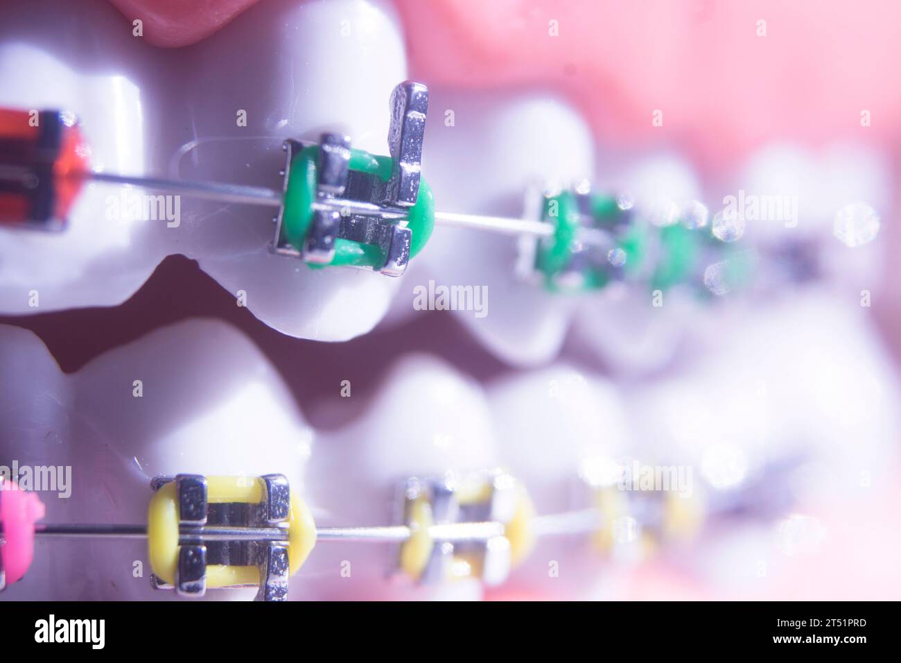 Modern Metal Brackets Aligner Straighterners Used To Correct Alignment