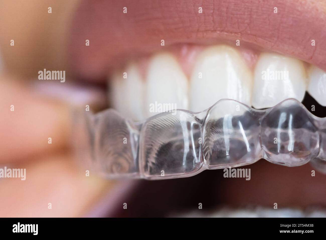 Clear Aligners and Dental Night Guard for Perfect Alignment Stock Photo