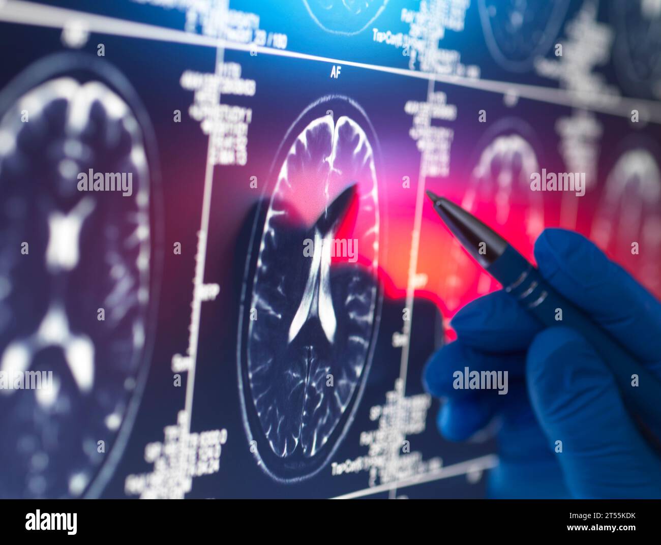 Doctor viewing a patients brain scan on screen Stock Photo