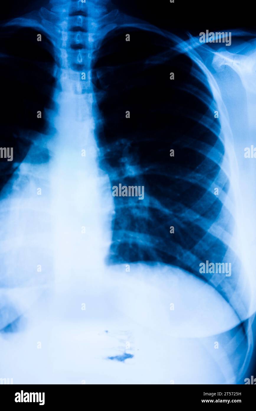 Lungs ribs xray scan test result Stock Photo Alamy