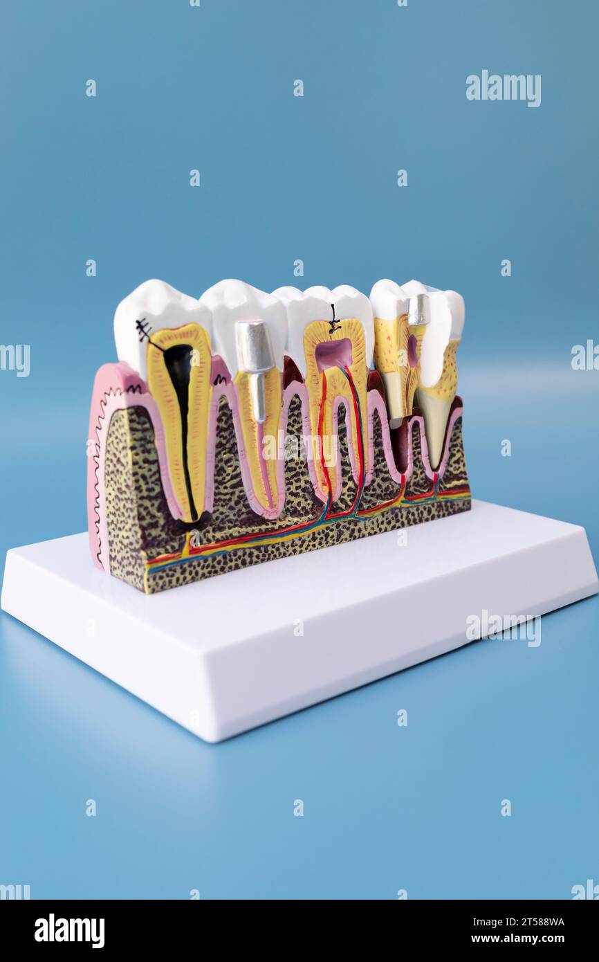 Dental Tooth Implant, Bridge Or Crown Model On Blue Background, Copy