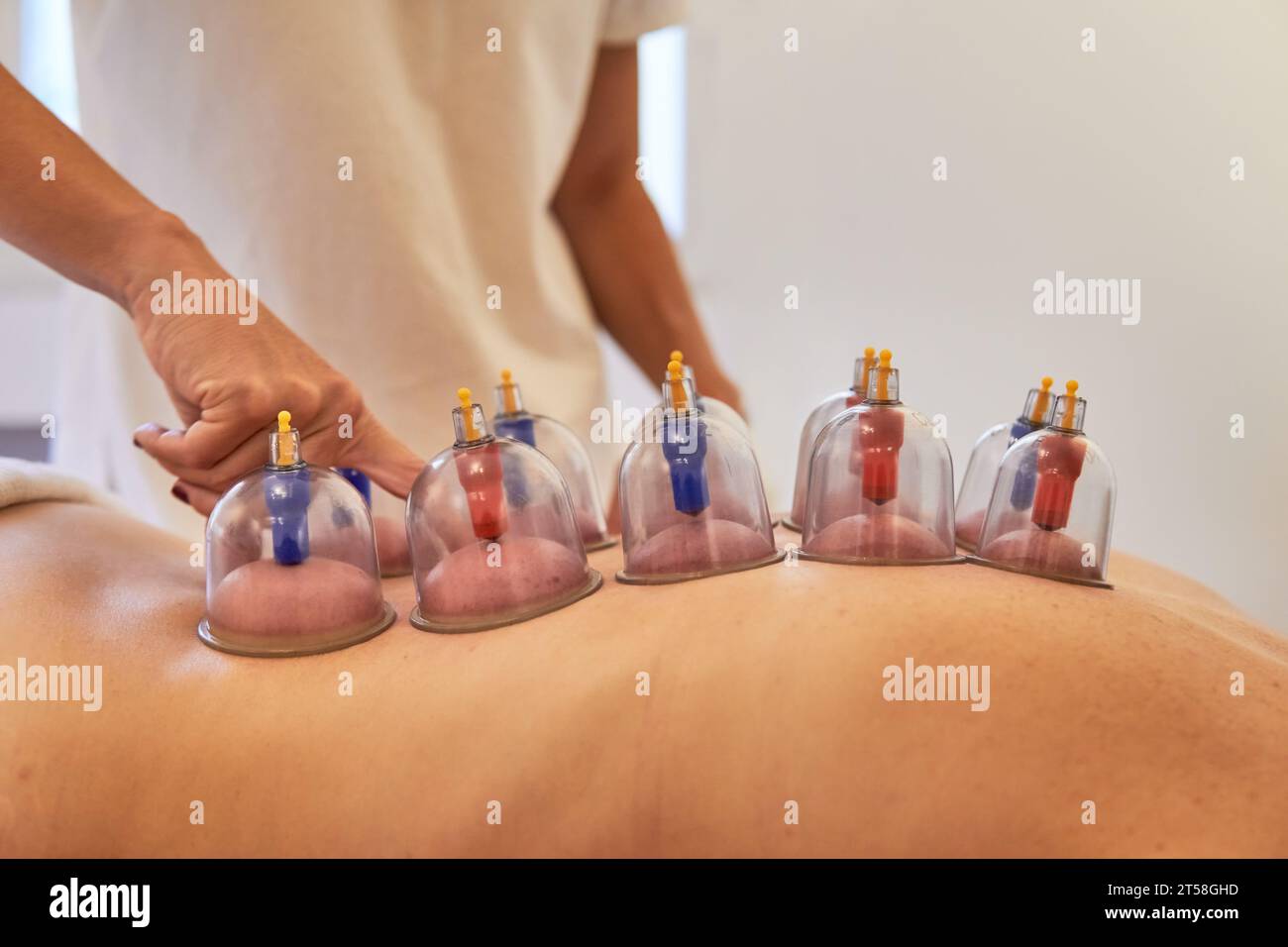 Therapist checking patient spine during cupping treatment. Healthcare ...