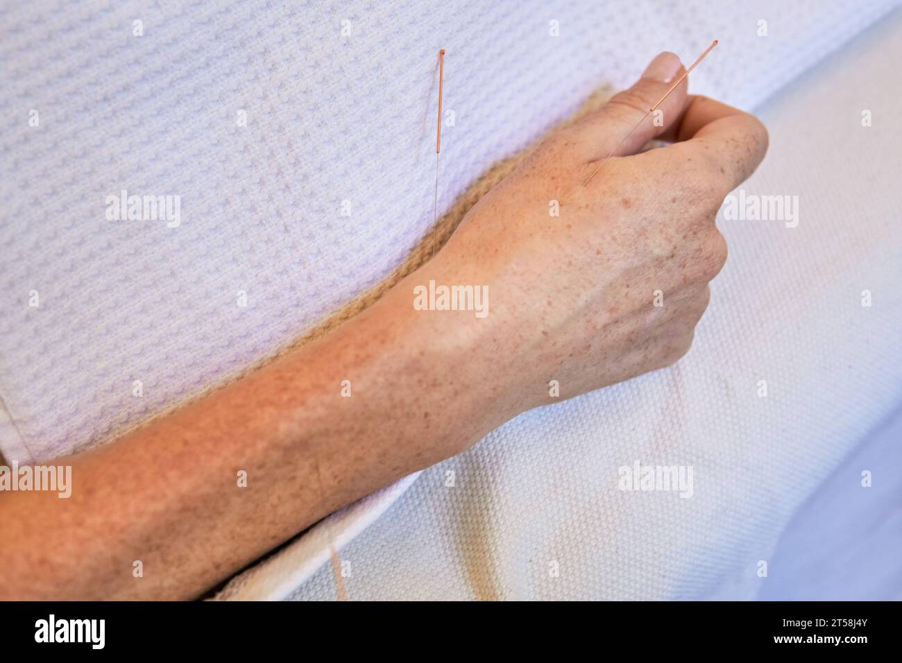 Needles on acupuncture uterus points of a woman hand during a