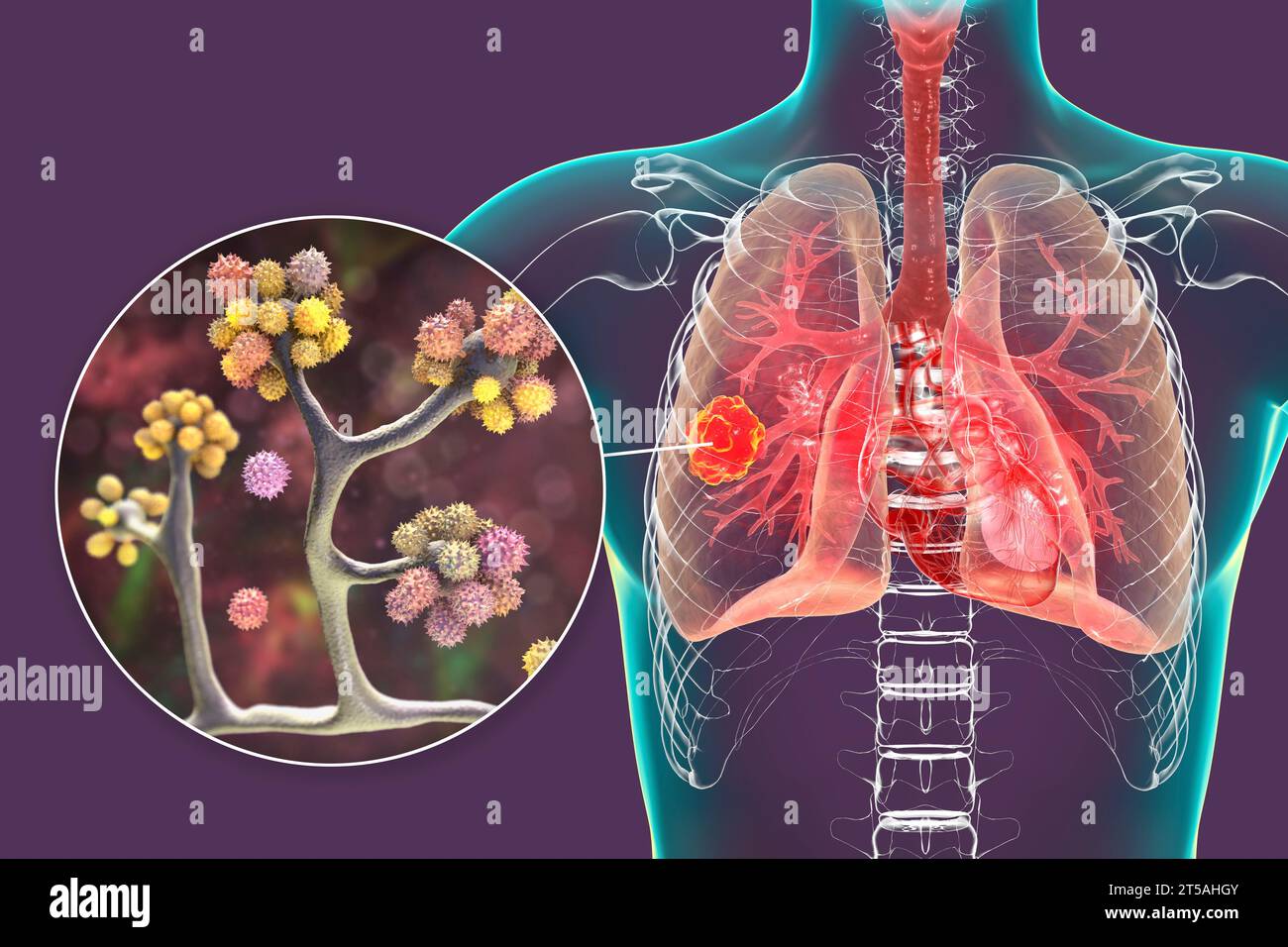 Lung mucormycosis lesion, illustration Stock Photo