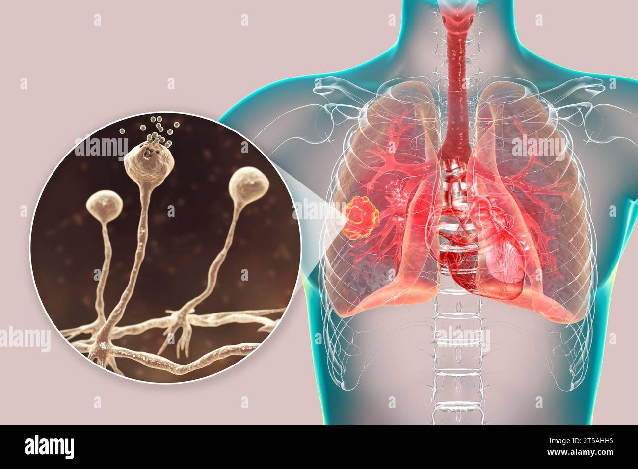 Lung mucormycosis lesion, illustration Stock Photo