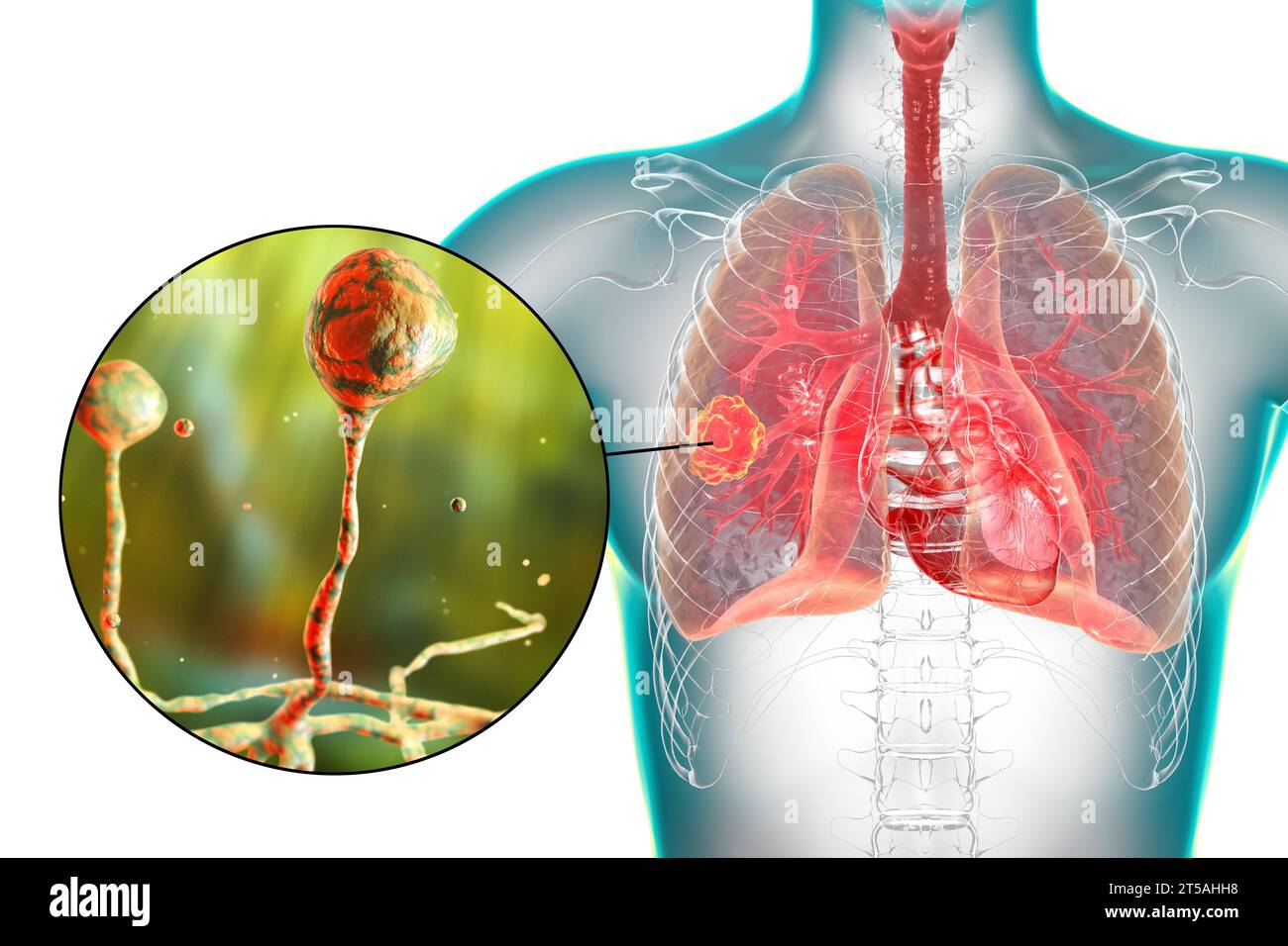 Lung mucormycosis lesion, illustration Stock Photo