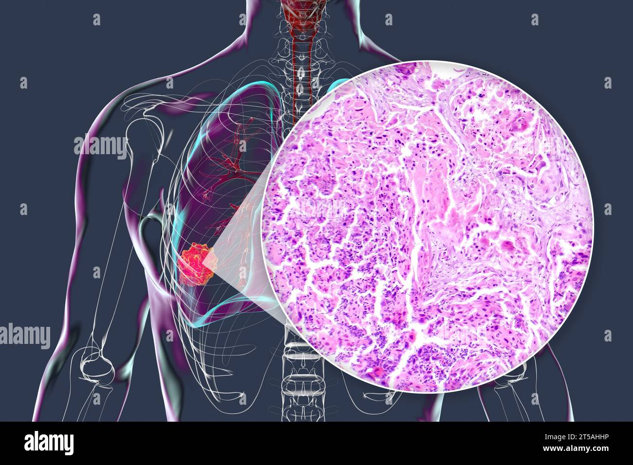 Squamous cell carcinoma of the lung hi-res stock photography and images ...