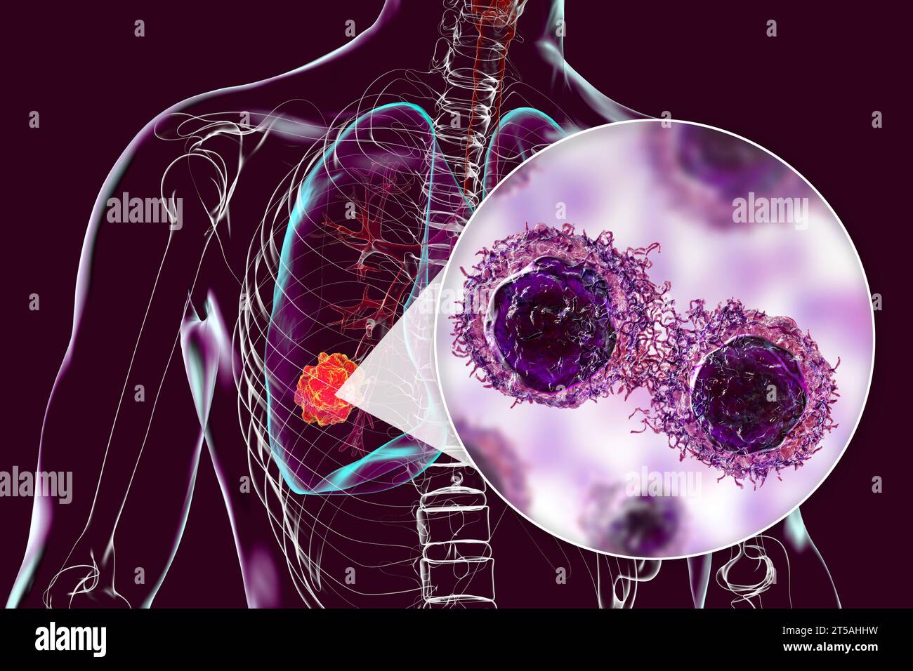 Lung cancer tumour and malignant cells, illustration Stock Photo