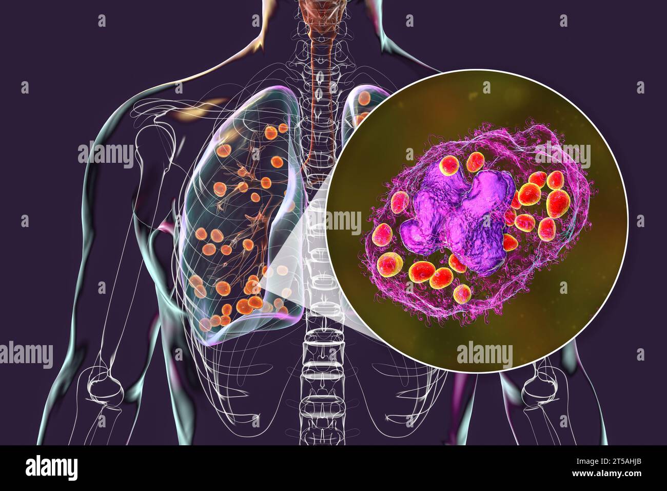 Lung histoplasmosis, a fungal infection caused by Histoplasma