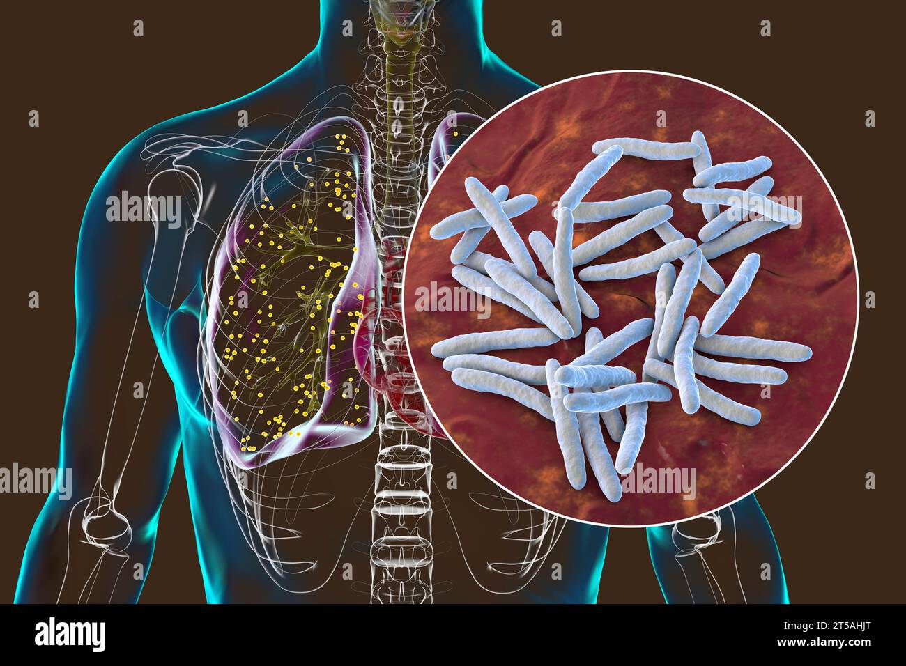 Lungs affected by miliary tuberculosis, illustration Stock Photo - Alamy