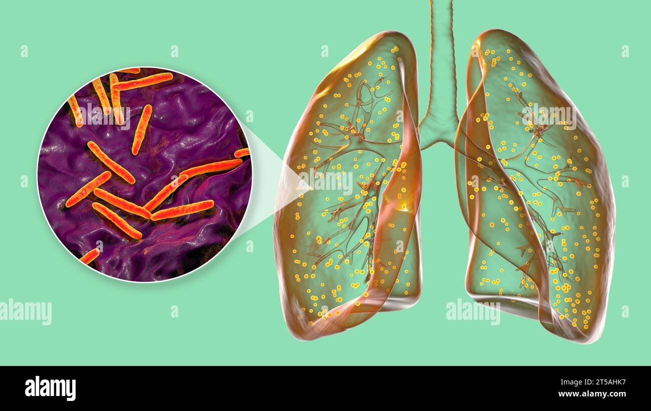 Lungs affected by miliary tuberculosis, illustration Stock Photo