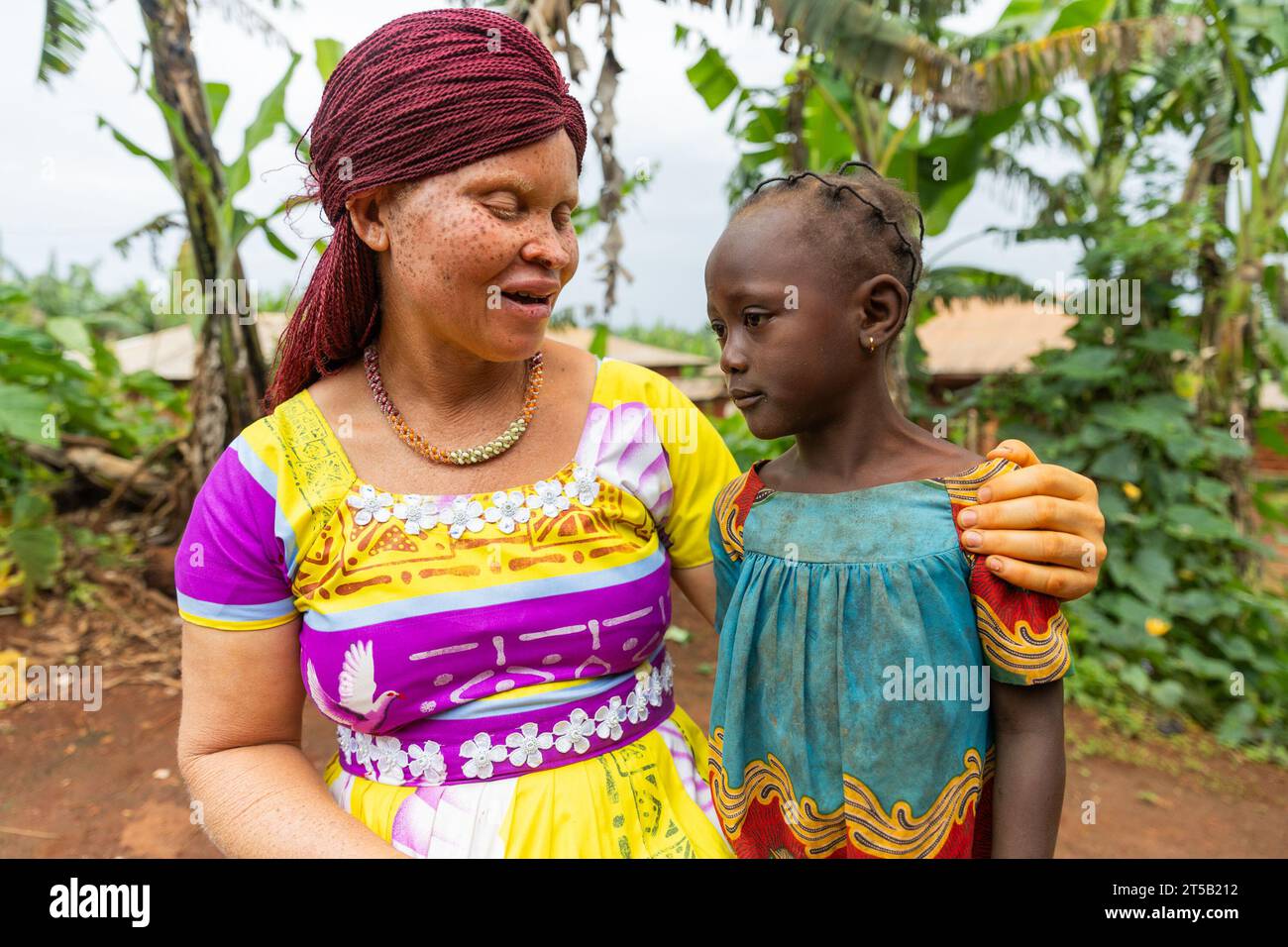 Young African Albino mother communicates with her daughter standing beside her. Stock Photo