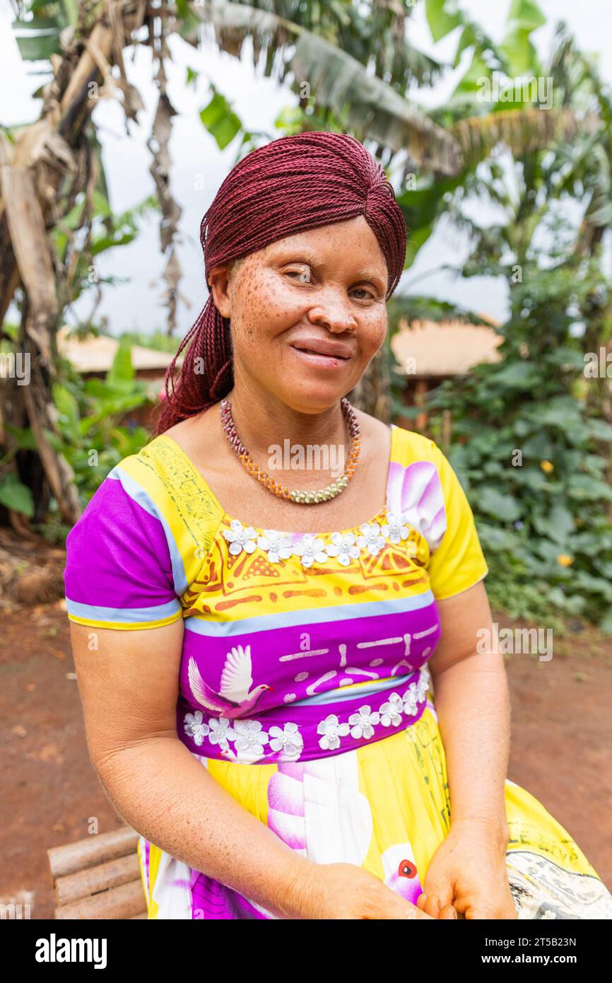 The inspiring story of conjoined twins who defied all odds of survival, image size:866x1390