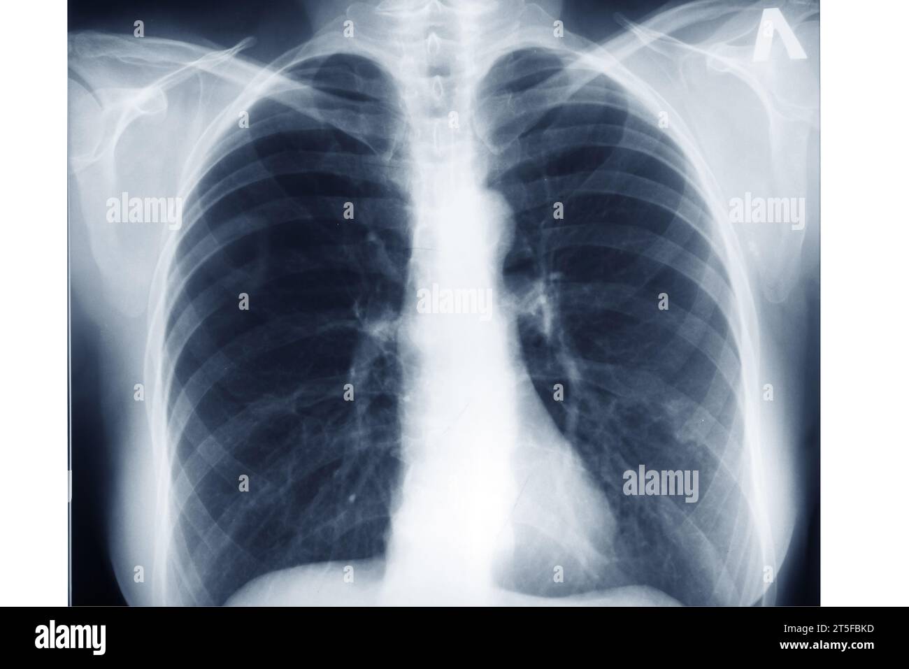 photo X-ray scan of the chest area of an adult. Lung radiography Stock Photo