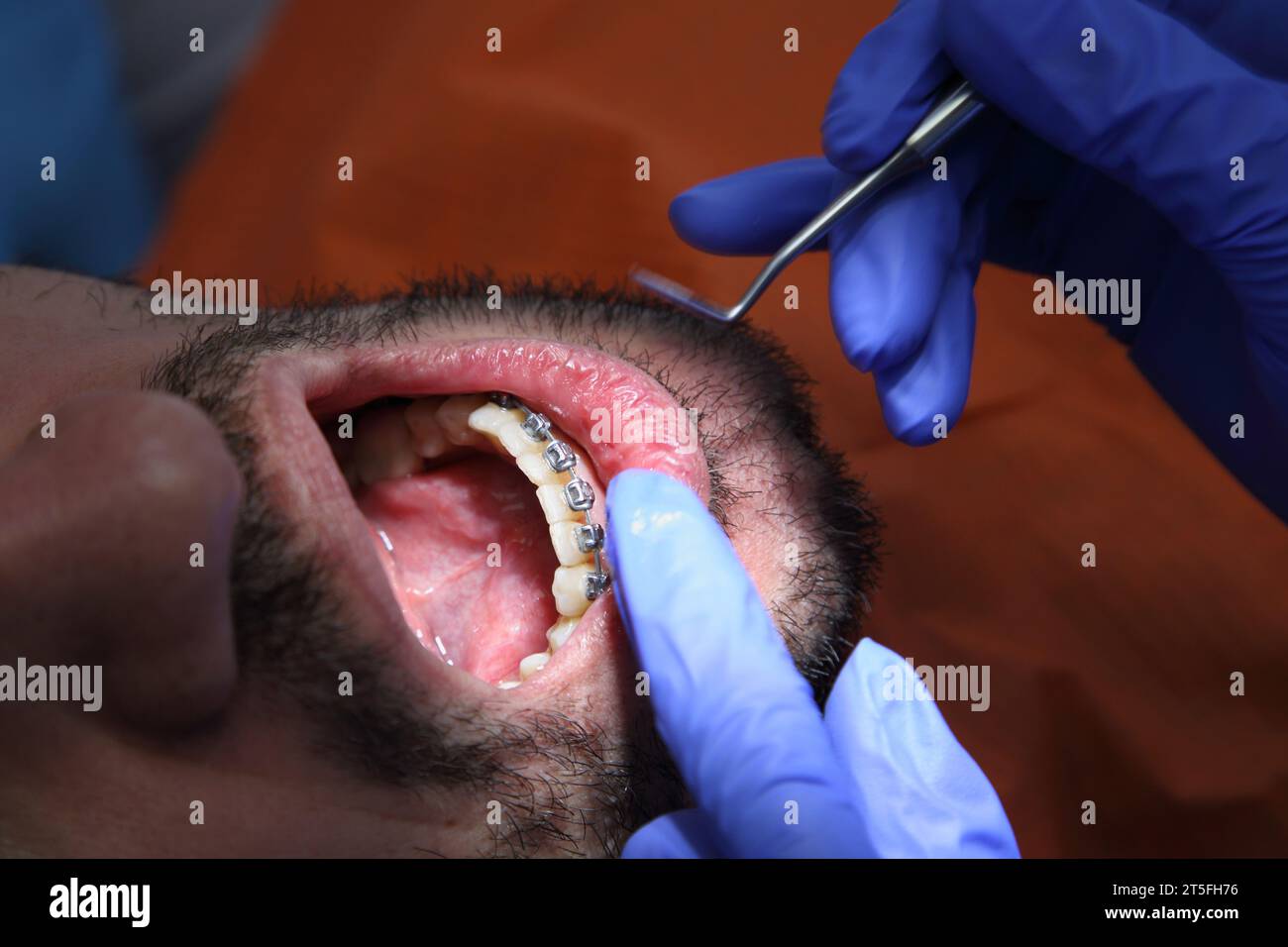 Dental office. Installation of dental braces at the dentist. The