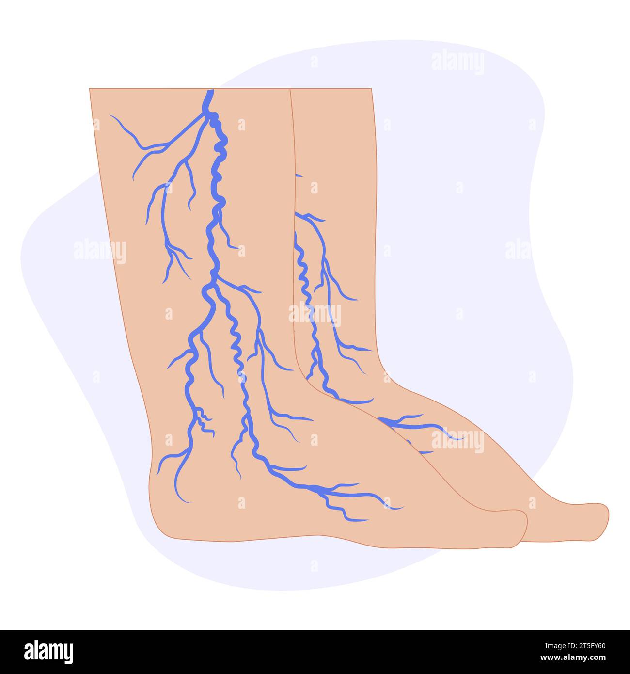 Varicose veins concept. Swelling and pain in female legs. Vascular disease diagnostic and treatment. Abnormal blood pressure, weak vein and valves. Ve Stock Vector
