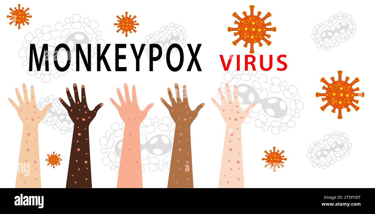 Monkeypox virus Illustration, vector of Hands with monkeypox, monkeypox virus outbreak pandemic design with microscopic view background Stock Vector