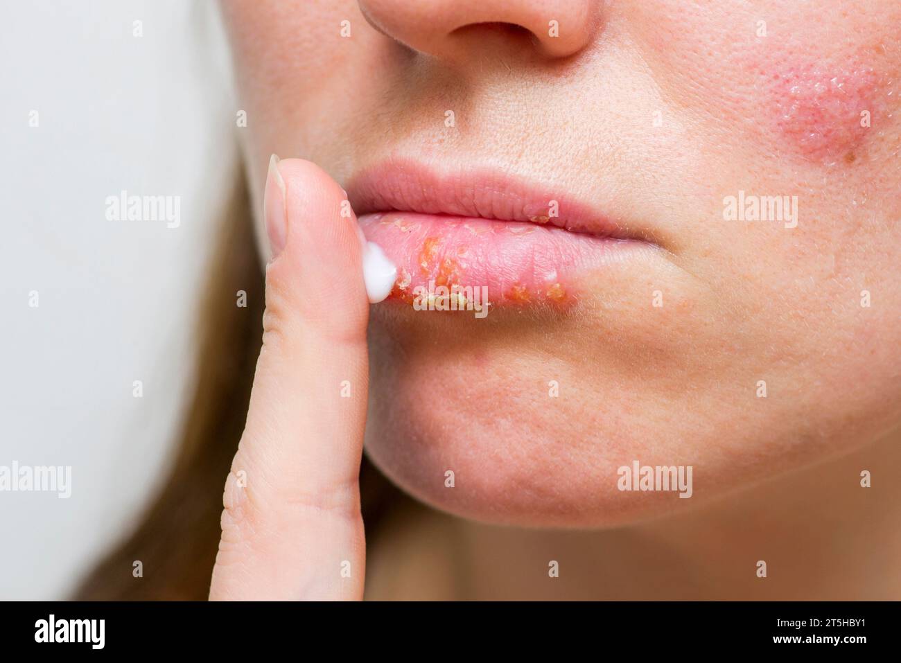 Young woman with cold sore applying cream on lips.  Stock Photo