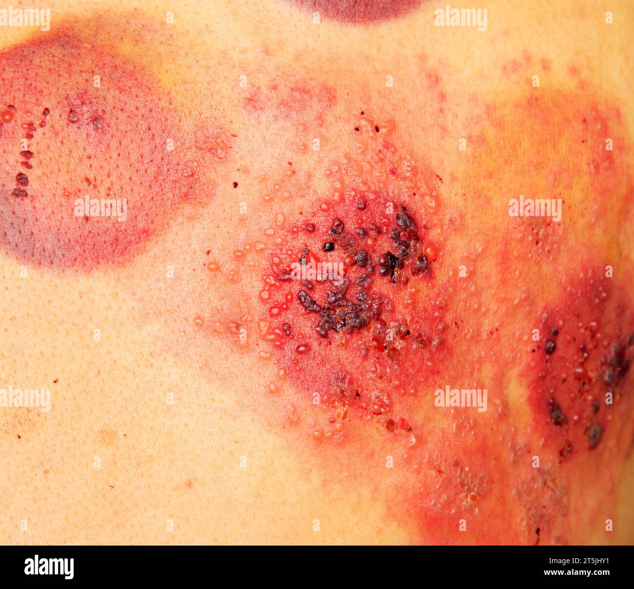 MORPHEUS8 : radiofréquence — Dr. Alizée Llanos Guyon — Dermatologie et  Médecine esthétique à Sète, image size:1300x1207