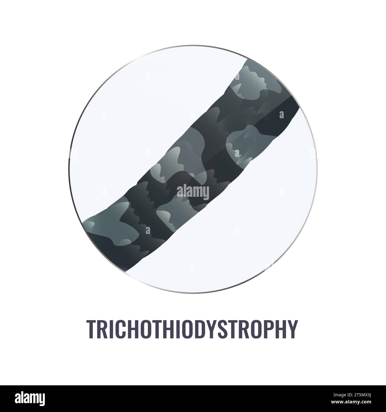 Trichothiodystrophy hair brittle disorder in close up Stock Vector