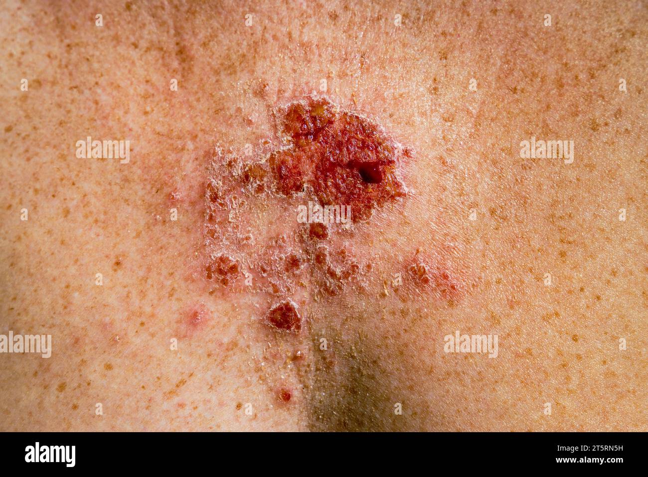 Superficial basal cell carcinoma reacting to imiquimod cream medication