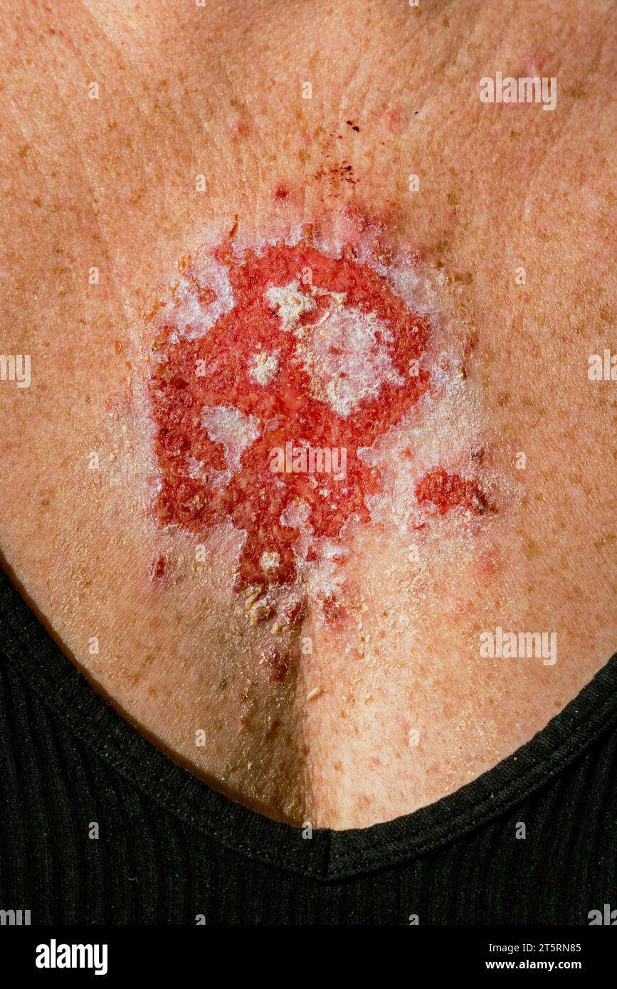 Superficial basal cell carcinoma reacting to imiquimod cream medication