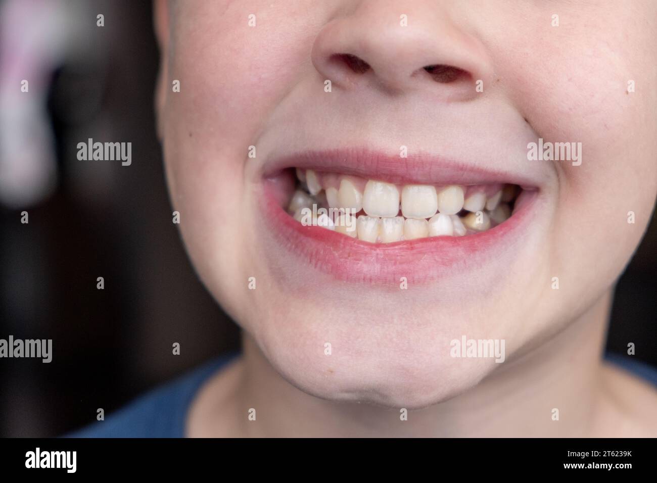 Child's crooked teeth. Young man showing crooked growing teeth Stock
