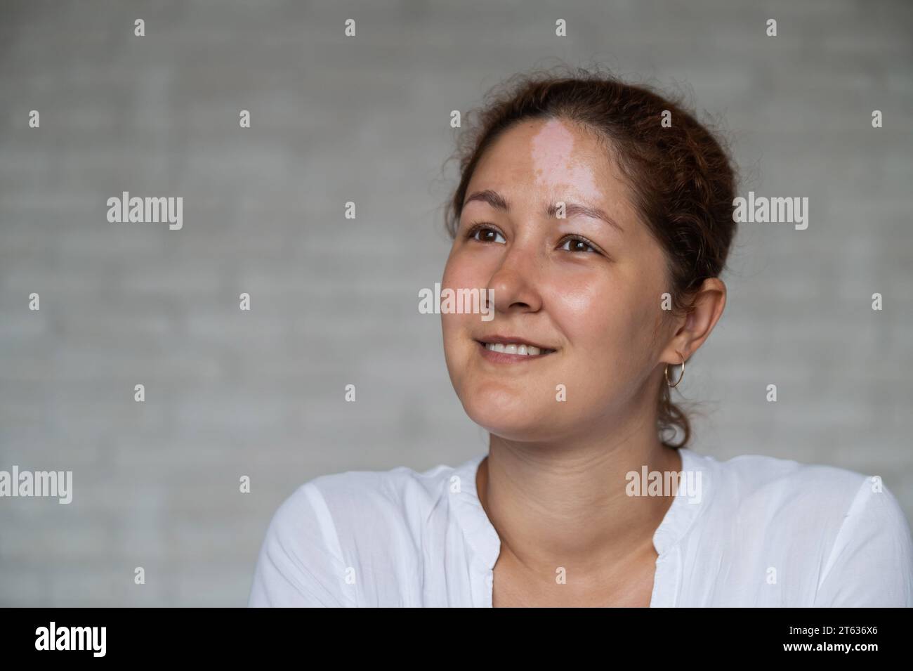 Portrait of a smiling woman with Vitiligo Disease. Stock Photo