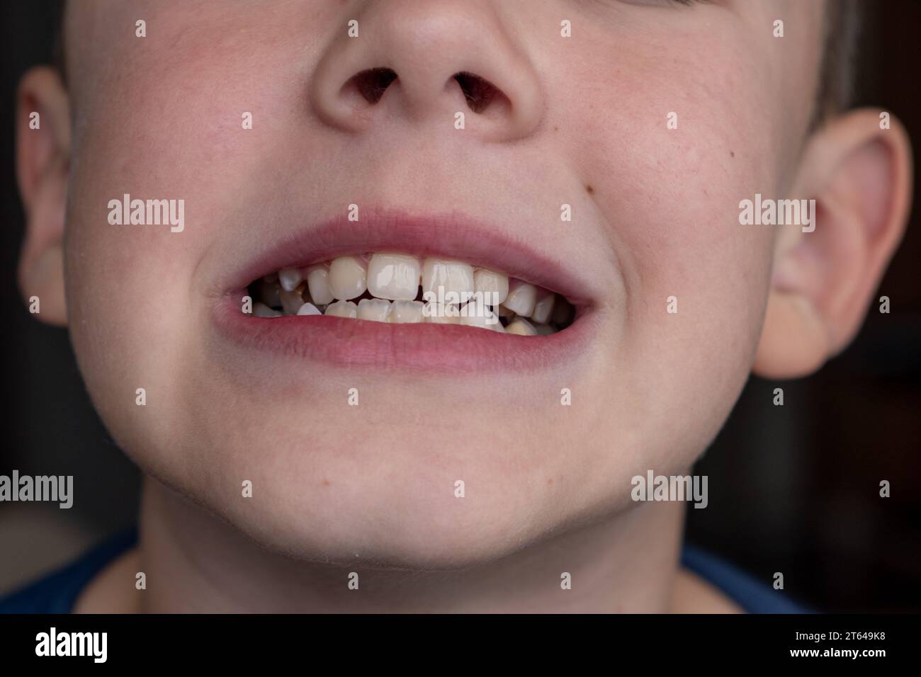 Child's crooked teeth. Young man showing crooked growing teeth Stock