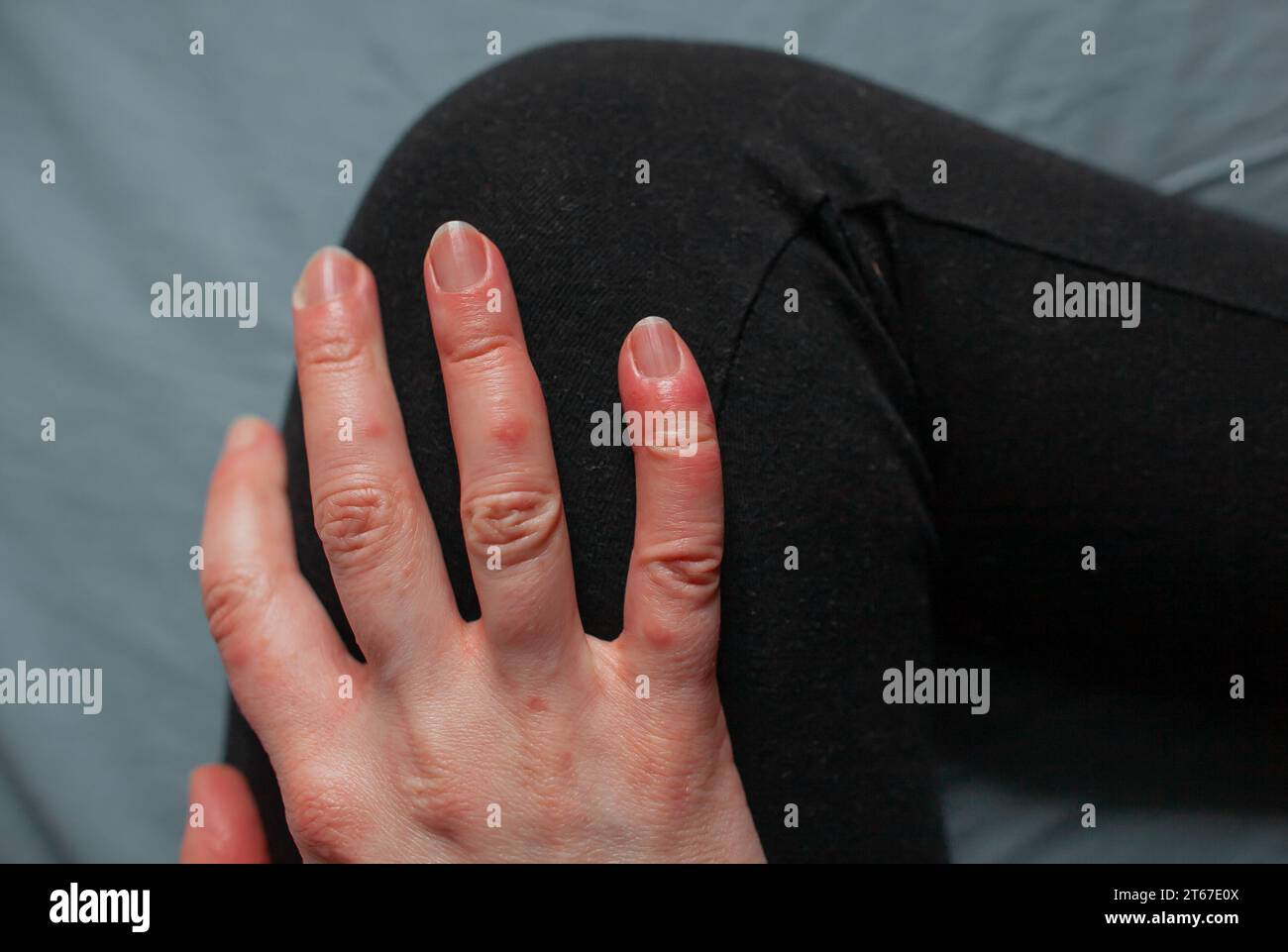 Close up photo of chilblains on fingers Hand of person with Raynaud's phenomenon and chilblains lesions on fingers Perniosis Red swollen fingers Stock Photo