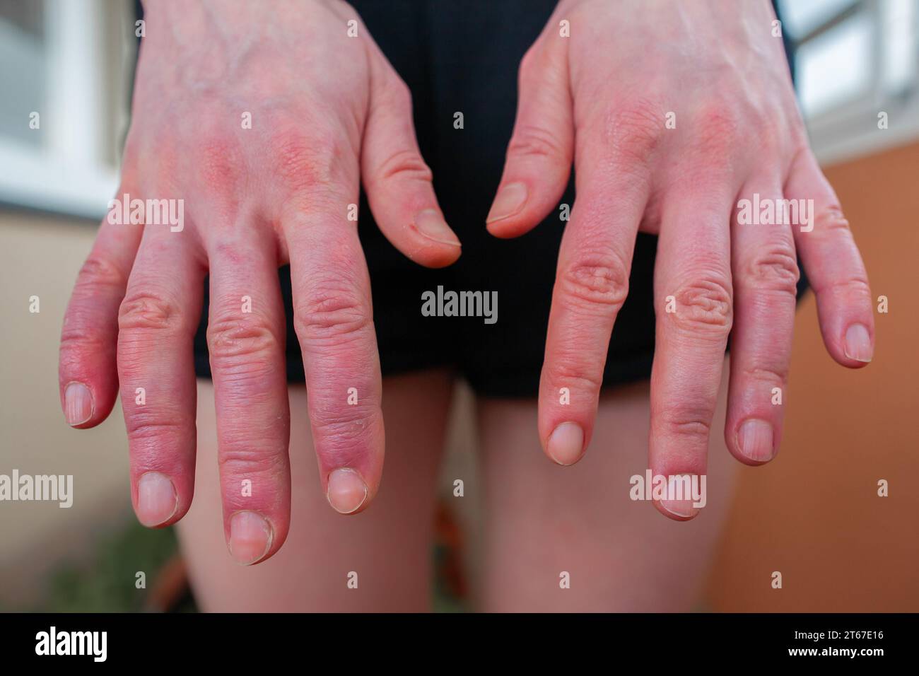 Foot of person with erythromelalgia, erythromelalgia flare up, skin