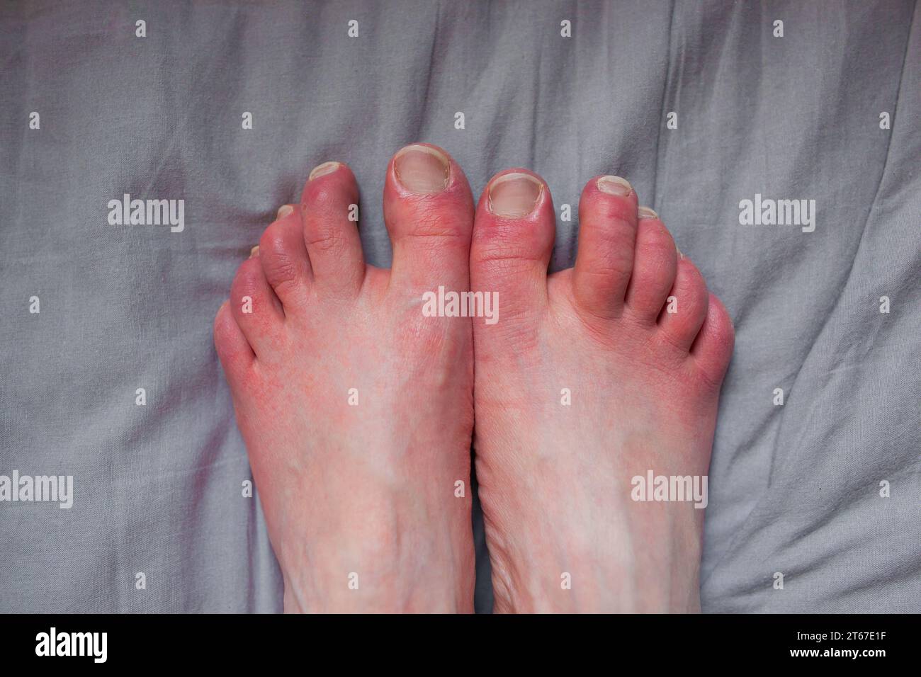 Feet of person with erythromelalgia, erythromelalgia symptoms flare, skin redness, burning