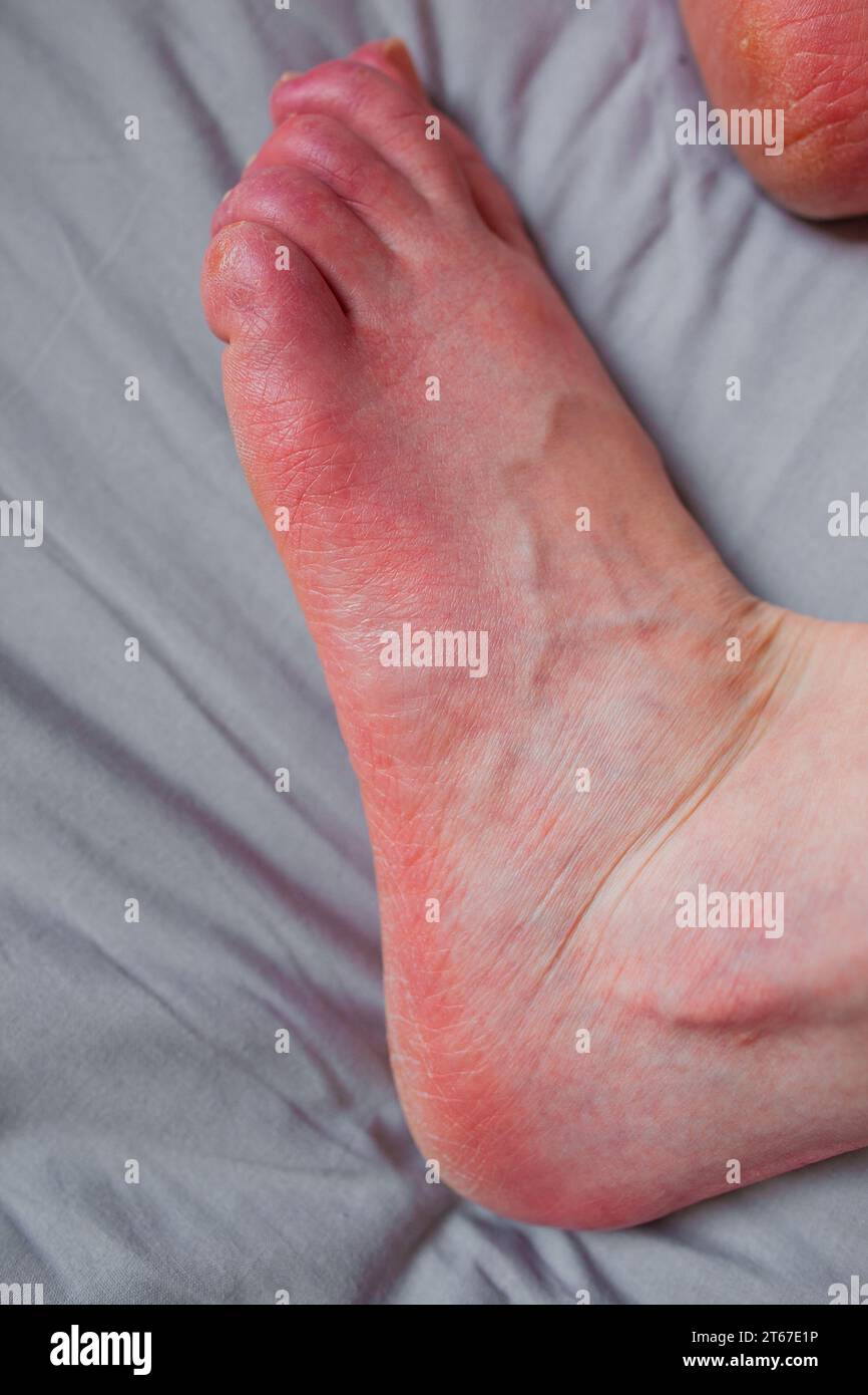 Foot of person with erythromelalgia, erythromelalgia flare up, skin