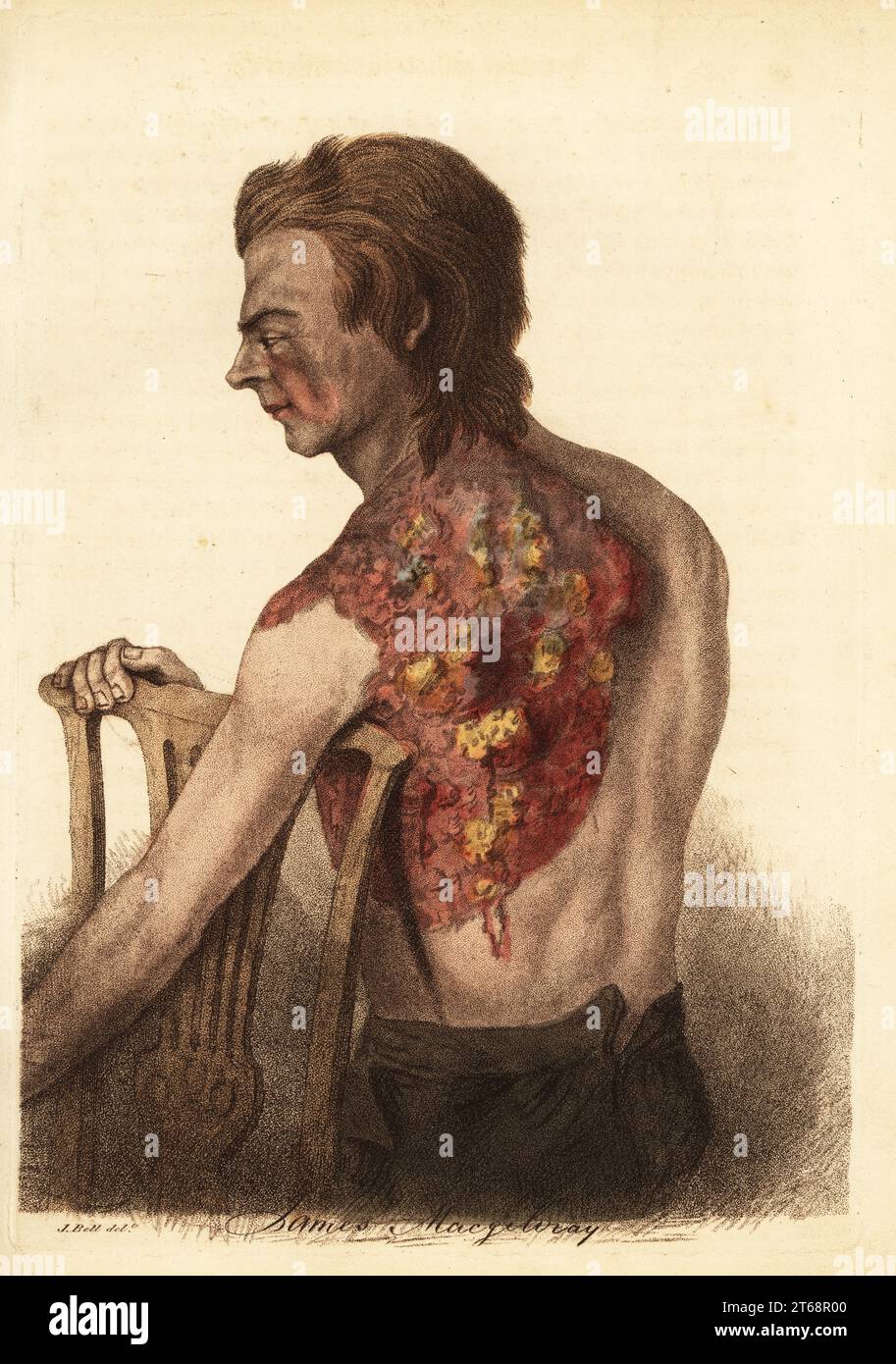 Soldier with an abscess from a gunshot wound to the shoulder. Sergeant M'Gillivray of the 68th (Durham) Regiment was shot in the shoulder in the Siege of Nijmegen, 1794. Entrance wound to the clavicle and exit at the scapula. Captured and imprisoned by the French for three years. Inflamed abscesses and ulcers cover his left shoulder and back. Cured by lancing, bathing and camomile decoction. James MacGilivray. Handcoloured copperplate engraving after an illustration by John Bell from his own Principles of Surgery, as they Relate to Wounds, Ulcers and Fistulas, Longman, Hurst, Rees, Orme and Br Stock Photo