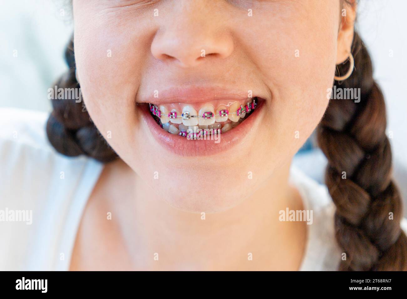 Close up mouth with brace hi-res stock photography and images - Page 10 -  Alamy