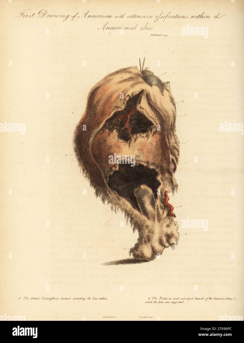 Aneurysmal tumor from the broken arm of a woman knocked down by a horse and cart, 1815. First drawing of aneurism and extensive ossifications with the aneurismal sac. Head of the humerus 1, lower part of the bone 2, arteria circumflexa humeri encircling the sac within 6, and the tortuous and enlarged branch of the humeral artery. Handcoloured copperplate engraving by William Archibald after an illustration by John Bell from his own Principles of Surgery, as they Relate to Wounds, Ulcers and Fistulas, Longman, Hurst, Rees, Orme and Brown, London, 1815. Stock Photo