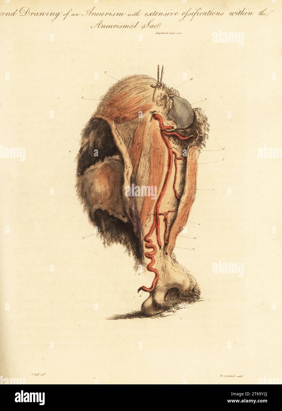 Aneurysmal tumor from the broken arm of a woman knocked down by a horse and cart, 1815. Second drawing of aneurism and extensive ossifications with the aneurismal sac. Humerus bone upper 1 and lower 2, sac 3, coraco brachialis a, biceps b, and deltoid c muscles, arteries f-m and basilic vein 7 stretched over the sac. Handcoloured copperplate engraving by William Archibald after an illustration by John Bell from his own Principles of Surgery, as they Relate to Wounds, Ulcers and Fistulas, Longman, Hurst, Rees, Orme and Brown, London, 1815. Stock Photo