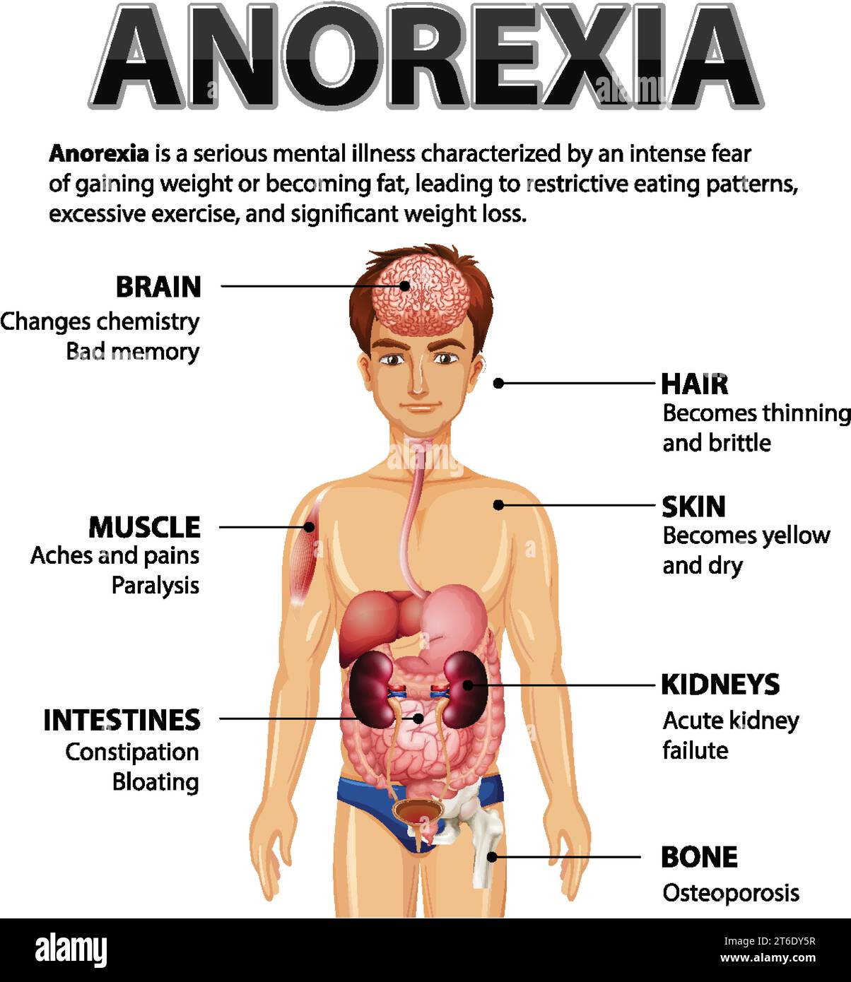 Illustration depicting the impact of Anorexia on various body functions ...