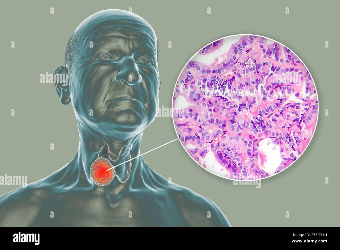 A 3D scientific illustration showcasing a human body with transparent skin, revealing a tumor in his thyroid gland, along with a micrograph image of p Stock Photo