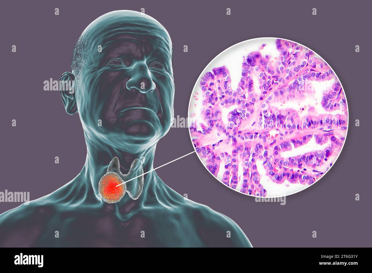 A 3D scientific illustration showcasing a human body with transparent skin, revealing a tumor in his thyroid gland, along with a micrograph image of p Stock Photo