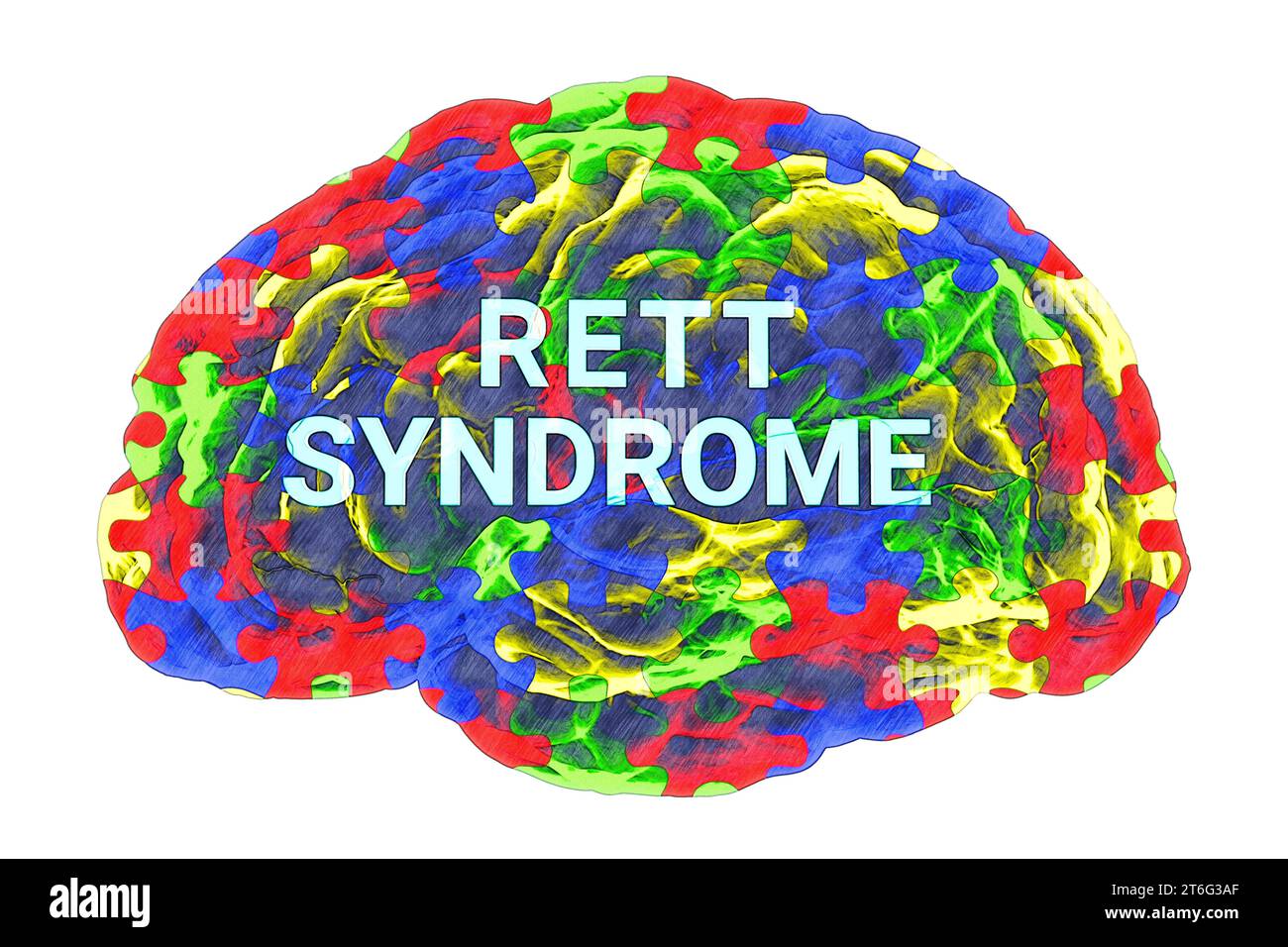 Text Rett Syndrome inside the anatomical model of a human brain, with a colorful puzzle pattern on its surface, highlighting the neurological basis of Stock Photo