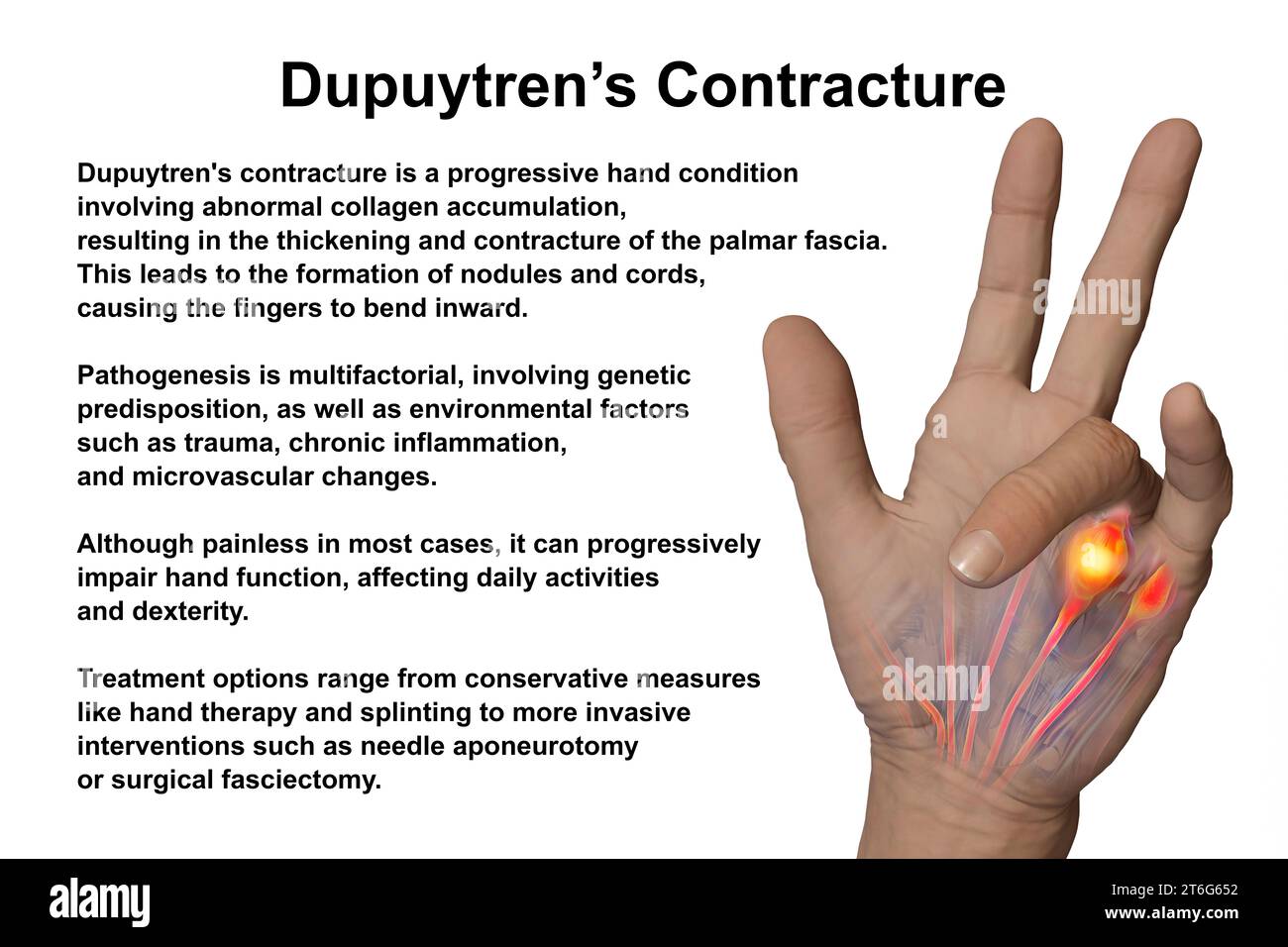 A 3D medical illustration displaying a patient's hand with Dupuytren's contracture, emphasizing