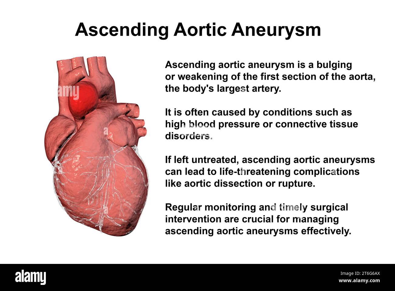 A human heart with an ascending aortic aneurysm, 3D illustration ...