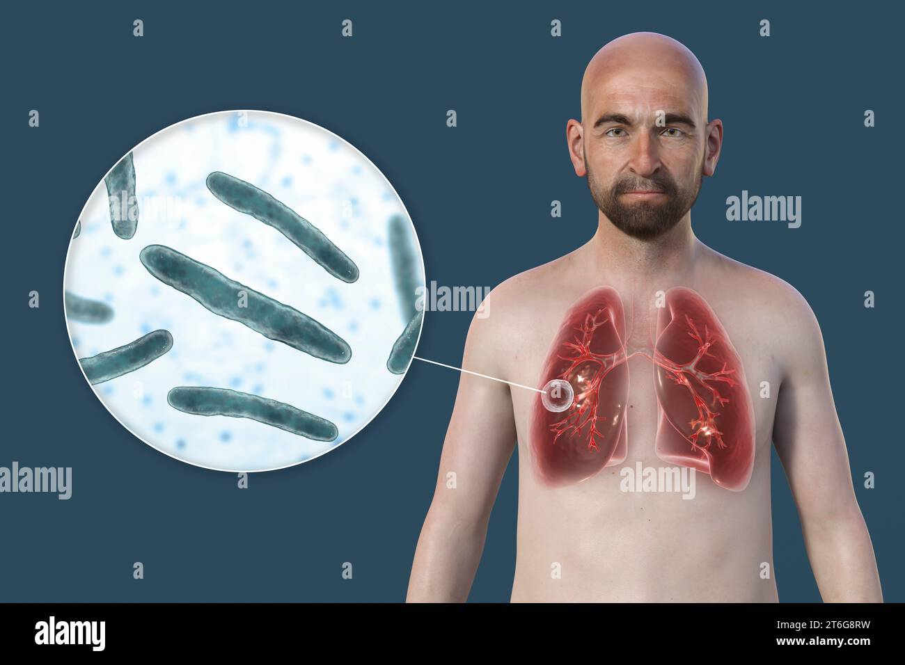 A 3D photorealistic illustration of the upper half of a man with transparent skin, showcasing the lungs affected by cavernous tuberculosis and close-u Stock Photo