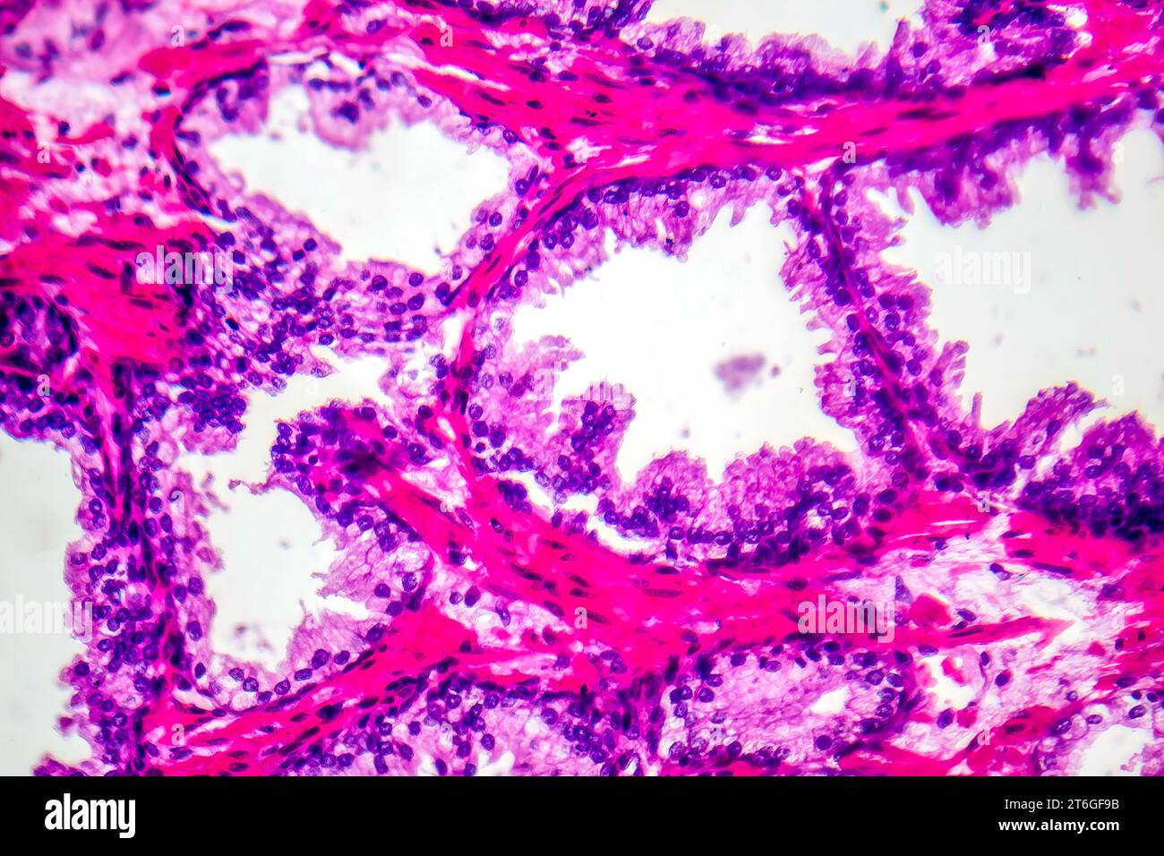 Micrograph of prostatic hyperplasia, showing increased glandular tissue