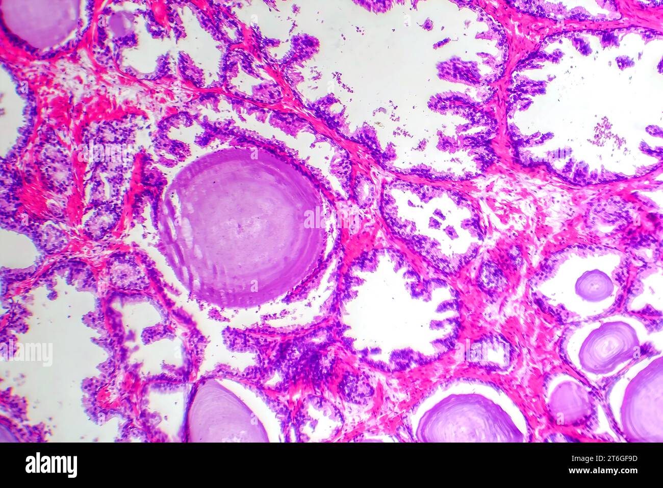 Micrograph of prostatic hyperplasia, showing increased glandular tissue