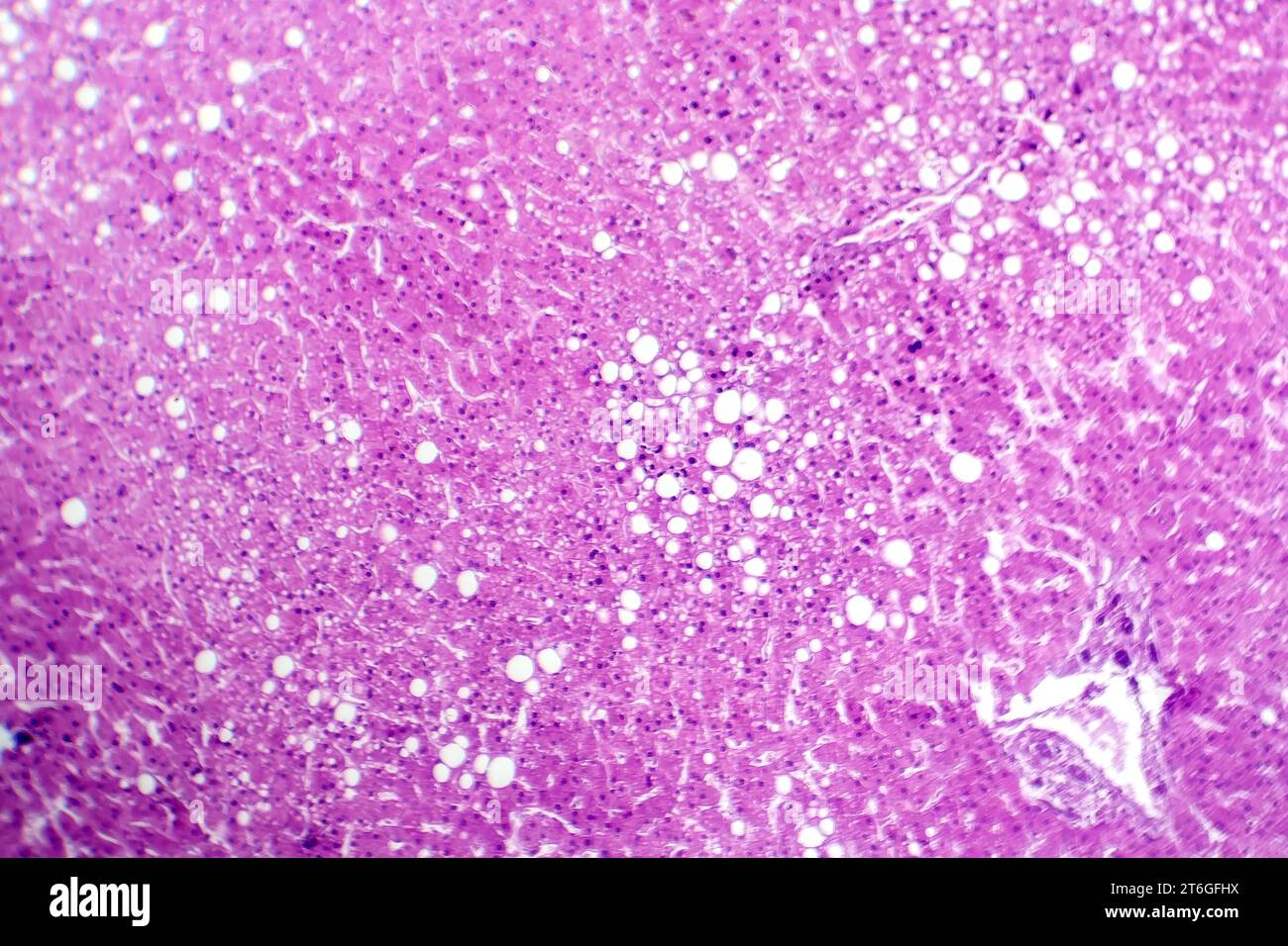 Photomicrograph of hepatic steatosis, revealing fat accumulation in ...