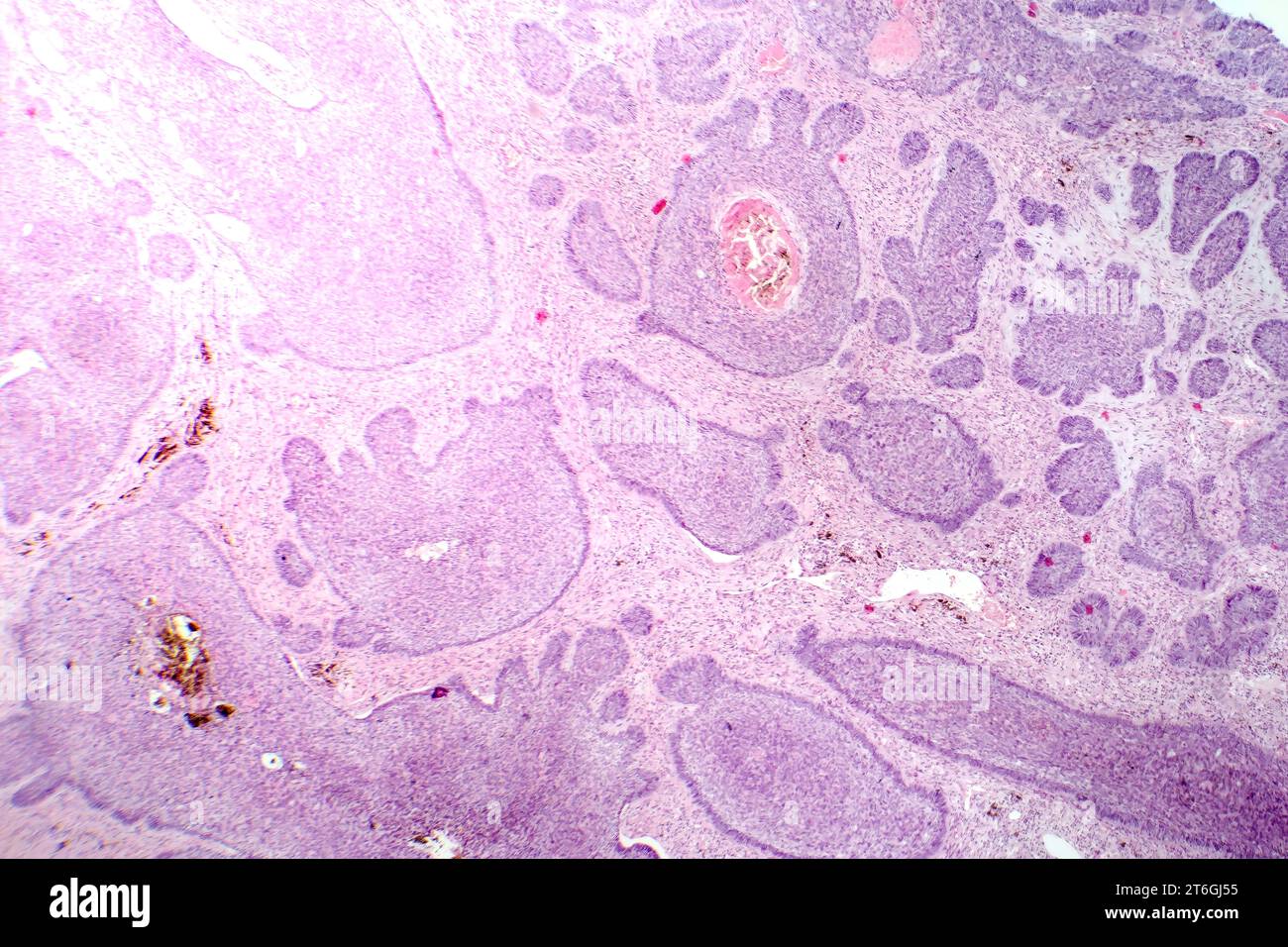 Photomicrograph of basal cell carcinoma, displaying malignant basal