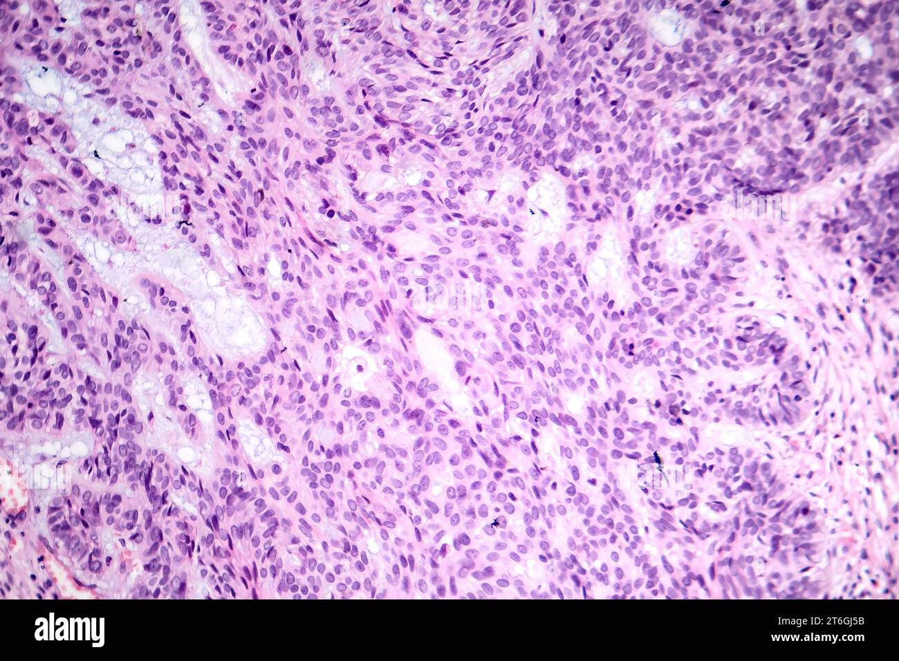 Photomicrograph of basal cell carcinoma, displaying malignant basal