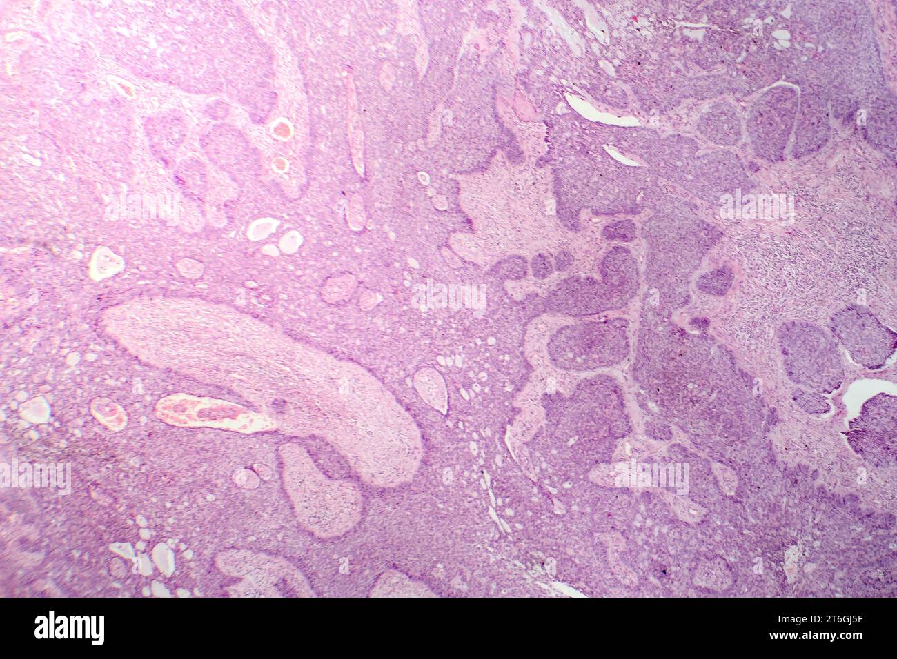 Photomicrograph of basal cell carcinoma, displaying malignant basal